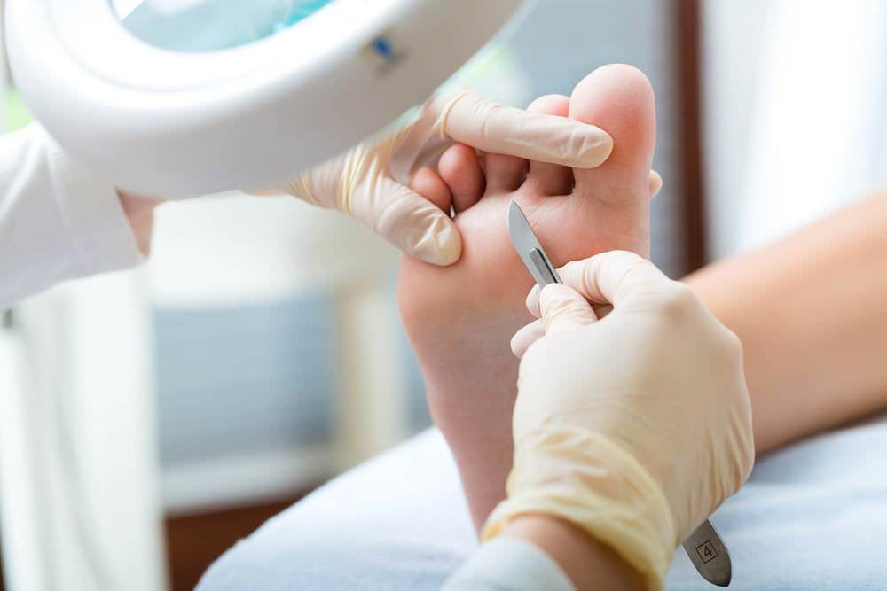 surgical-verruca-removal-kent-sport-podiatry-united-kingdom